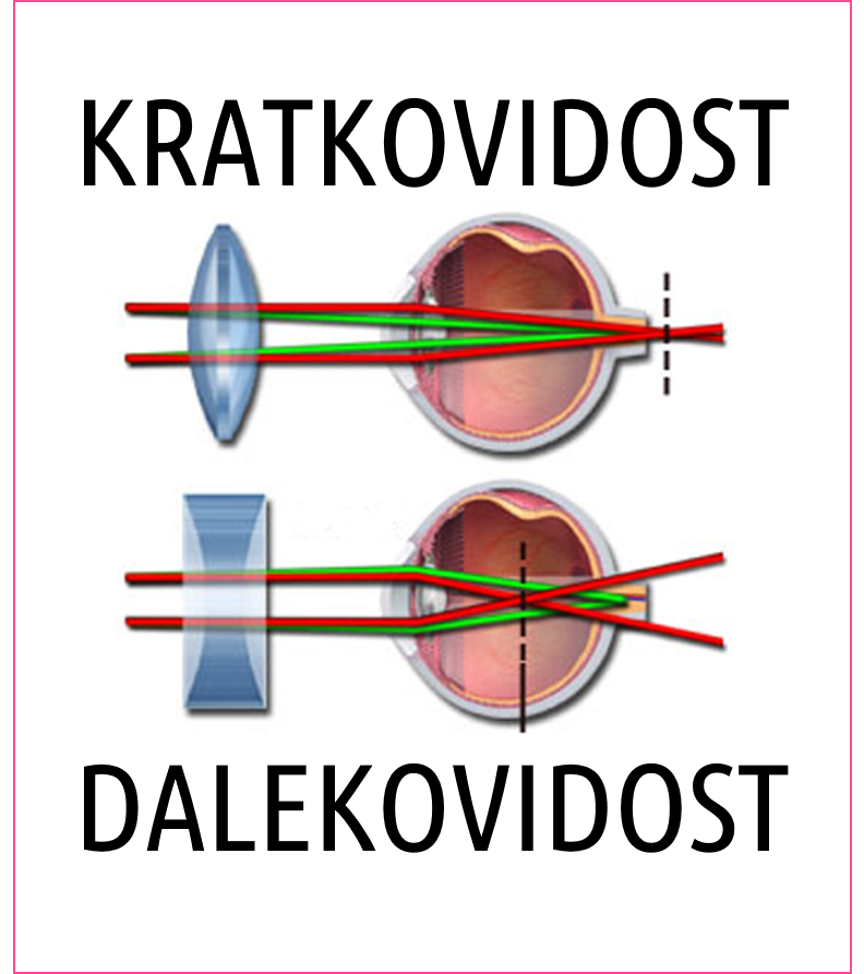 kratkovidost-dalekovidost